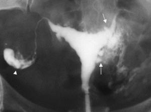 C’est la Semaine de lutte contre l’ENDOMÉTRIOSE: Une femme sur 15 est atteinte. Sans le savoir ? – Prévention