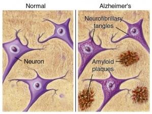 ALZHEIMER: La protéine qui prédit la vitesse de progression de la maladie  – Neurology
