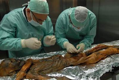 Ötzi aurait souffert de la maladie de Lyme