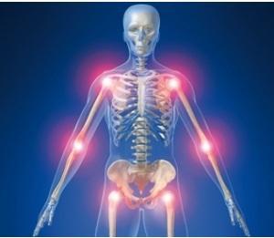 ARTHOSE du genou: Protelos prouve sa grande efficacité  – IOF-ESCEO Pre-clinical Symposium et Osteoporosis International