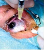 MYOPIE en ASIE: Travailler à en perdre la vision – The Lancet