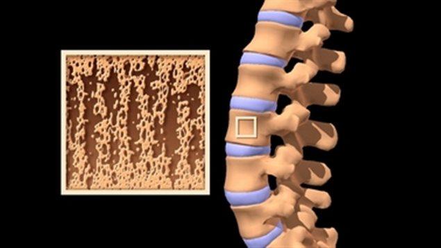Des problèmes osseux diagnostiqués plus rapidement grâce à la NASA