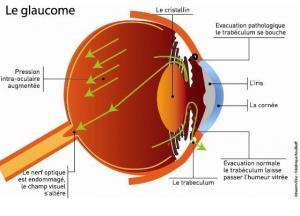 GLAUCOME: Cibler ses origines plutôt que ses symptômes – Inserm et PLoS ONE (à paraître)