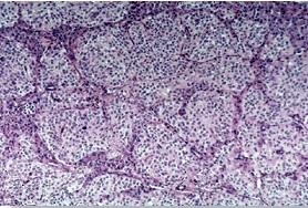 CANCER du PANCRÉAS: Amgen stoppe ses essais sur le Ganitumab  – Phase III