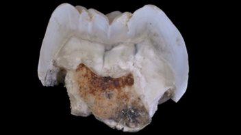 La troisième molaire supérieure droite d'un <i>Paranthropus robustus</i>.