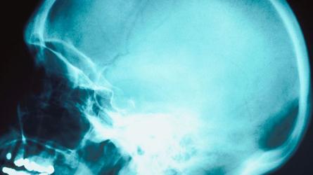 Le stress aurait des conséquences sur le cerveau