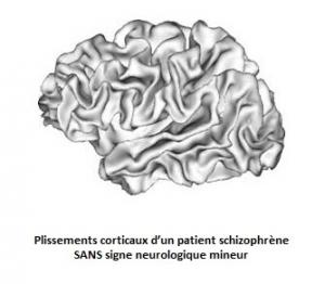 La SCHIZOPHRÉNIE déforme le cerveau de certains patients  – Schizophrenia Bulletin