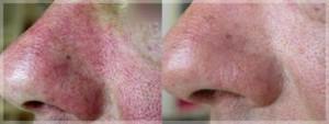 Comment traiter les varicosités du visage ?
