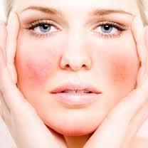 Comment traiter les varicosités du visage ?