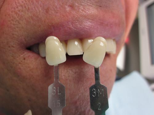 Empreinte Optique Trios (r) 3 Shape Cas clinique couronne Tout-Céramique sur 22