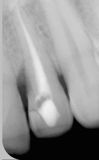 Empreinte Optique Trios (r) 3 Shape Cas clinique couronne Tout-Céramique sur 22