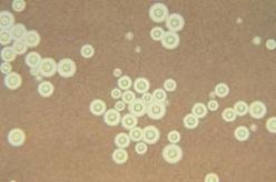Epidurales de STÉROIDES aux U.S.: 64 cas de méningite fongique, 7 décès d’AVC – CDC