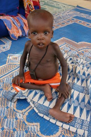 Enfant malnutri © ACF, Christina Lionnet - Tchad