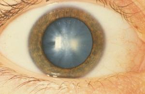 Le TABAGISME accroît de 50% le risque de cataracte – Investigative Ophthalmology & Visual Science