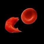 « Breack the Sicle Circle » le beau slogan de la SCDAA contre la Drépano !