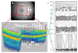 SCLÉROSE en plaques: L’œil, une fenêtre ouverte sur le cerveau – The Lancet Neurology et les Archives of Neurology
