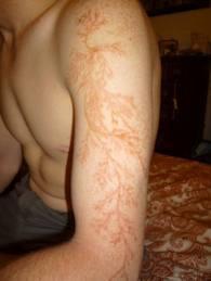Les figures de Lichtenberg: comment la foudre peut tatouer des fractales sur votre peau!