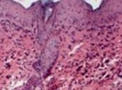 L’ECZÉMA aurait aussi cause génétique PLoS