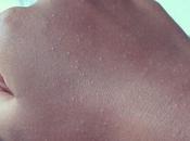 Petite reaction allergique climat pense (sur chaque bras)