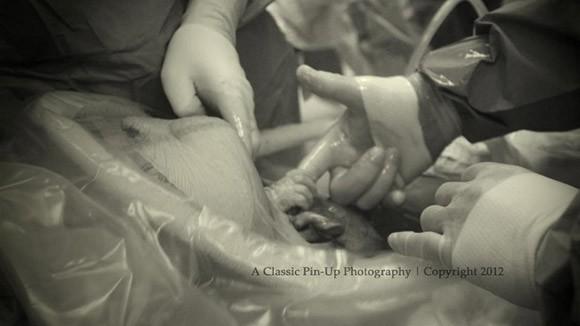 Un bébé tient le doigt du chirurgien juste avant de naître