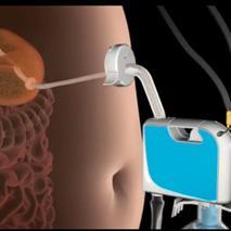Polémique - Se perforer l'estomac pour garder la ligne