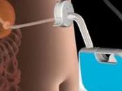 Polémique perforer l’estomac pour garder ligne