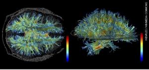 CANNABIS et SCHIZOPHRÉNIE: Le risque de psychose à nouveau débattu  – F1000 Medicine Reports