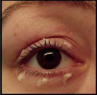 Remède contre les yeux gonflés : les gouttes bleues d'Innoxa