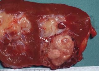 Effets des mutations BAP1 et PBRM1 sur la survie dans le carcinome rénal à cellules claires sporadique: analyse rétrospective avec validation indépendante