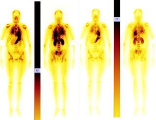 Bevacizumab + paclitaxel versus bevacizumab + capecitabine comme traitements de première ligne dans le cancer du sein métastatique HER2-négatif : résultats intermédiaires d’efficacité de l’essai de phase 3 de non - infériorité randomisé, ouvert TURANDOT