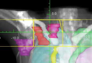 Traitement adjuvant à base de docetaxel, doxorubicine, et cyclophosphamide dans le cancer du sein avec atteinte ganglionnaire : 10 années de suivi de l’essai randomisé de phase 3 BCIRG 001