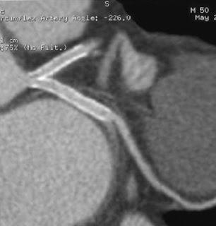 Ballonnets à élution de Paclitaxel, stents imprégnés de Paclitaxel et angioplastie par ballonnet chez des patients atteints de resténose après implantation d’un stent imprégné de médicament (ISAR-DESIRE 3) : une étude ouverte et randomisée