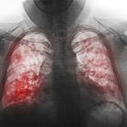 Pneumonie aigüe et système cardiovasculaire