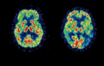 Des plaques et des «écheveaux» anormaux se forment dans le cerveau. - 6 choses que vous ignorez de l’Alzheimer