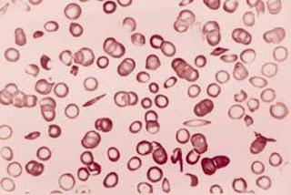 Transfusion préopératoire comme alternative dans l’anémie à hématies falciformes (Étude TAPS) : un essai multicentrique randomisé et contrôlé