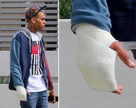Chris Brown blessé après la bagarre avec Frank ocean apparaît avec un plâtre à la main