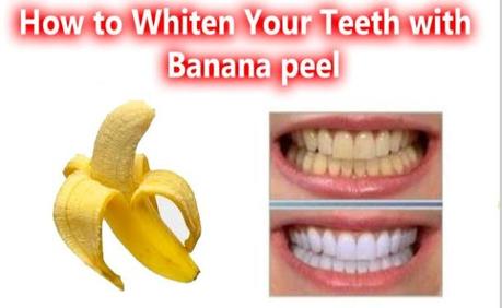 La solution pour des dents blanches ? La peau de banane