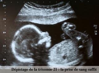 Dépistage sanguin de la trisomie 21