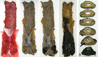 Chirurgie laparoscopique versus chirurgie ouverte dans le cancer du rectum (COLOR II) : résultats à court terme d’une étude de phase 3 randomisée