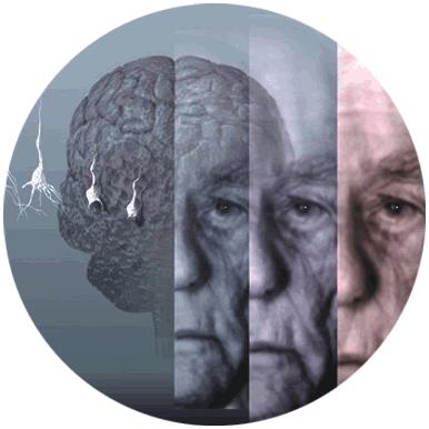 3 fois plus de maladies d'Alzheimer d'ici 2050