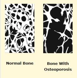 OSTÉOPOROSE: Brocolis et épinards pour vaincre la fragilité osseuse – PNAS