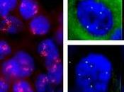 Rechutes niveau Système Nerveux Central chez patientes atteintes cancer sein HER2-positif ayant reçu n’ayant trastuzumab traitement adjuvant sous-étude rétrospective l’essai HERA (BIG 1-01)