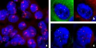 Rechutes au niveau du Système Nerveux Central chez des patientes atteintes de cancer du sein HER2-positif ayant reçu ou n’ayant pas reçu de trastuzumab en traitement adjuvant : sous-étude rétrospective de l’essai HERA (BIG 1-01)