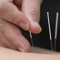 L'acupuncture soulage les petits maux de la grossesse