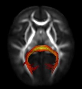 AUTISME: La lenteur du regard, dès 7 mois, un indice de TSA – American Journal of Psychiatry