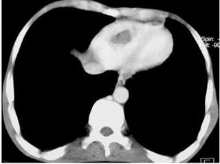 La Protéine Disulfide Isomérase comme cible antithrombotique