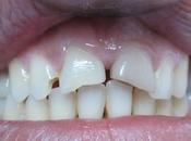 LAVA Ultimate restauration esthétique dans demi journée.