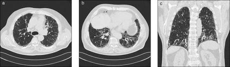 Variantes génétiques associées à une susceptibilité de fibrose pulmonaire idiopathique et mortalité: étude d’association pangénomique