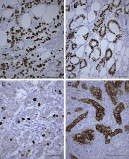 Pertuzumab, trastuzumab, et docetaxel pour le traitement du cancer du sein métastatique HER2-positif (Étude CLEOPATRA): résultats globaux de survie d’une étude de phase 3 randomisée, en double aveugle et contrôlée par placebo