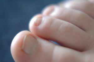 Comment traiter la mycose des ongles?
